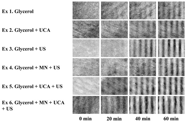 Transdermal Drug Delivery Aided by an Ultrasound Contrast Agent: An In