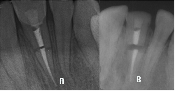 The Horizontal Root Fractures. Diagnosis, Clinical Management and Three