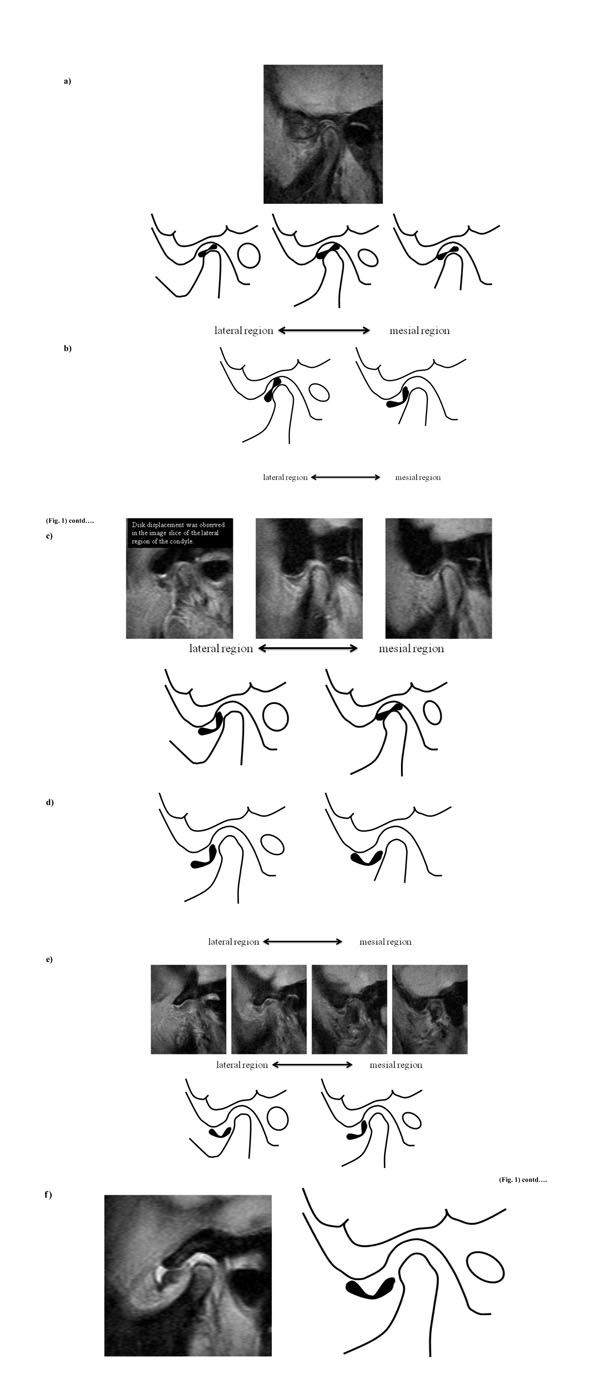 an analysis of the topic of the articular eminence It attaches to the articular eminence, the articular disc and the neck of the mandibular condyle cephalometric analysis topic cephalometric analysis is the clinical application of cephalometry. an analysis of the topic of the articular eminence It attaches to the articular eminence, the articular disc and the neck of the mandibular condyle cephalometric analysis topic cephalometric analysis is the clinical application of cephalometry.