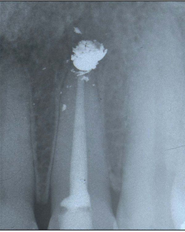 Extrusion of Endodontic Filling Materials MedicoLegal Aspects. Two