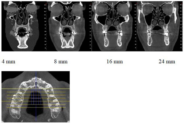 Relationship Between the Thickness of Cortical Bone at Maxillary Mid