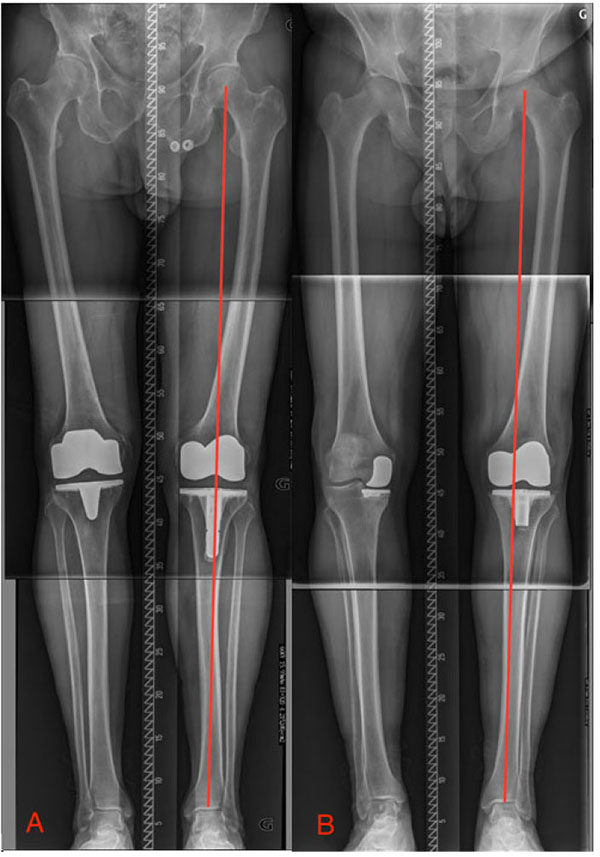 Anatomic Versus Mechanically Aligned Total Knee Arthroplasty For ...