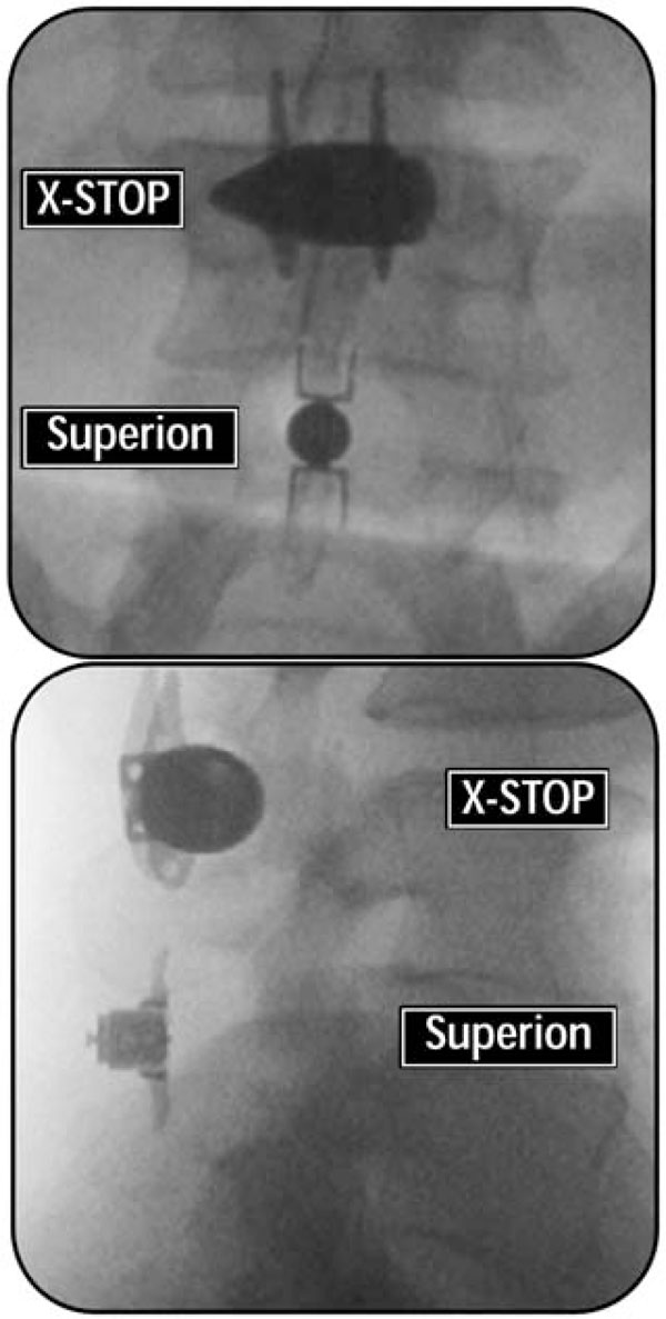 Minimally Invasive Treatment of Moderate Lumbar Spinal Stenosis with