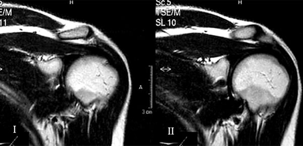 Bilateral Suprascapular Nerve Entrapment by Ganglion Cyst Associated