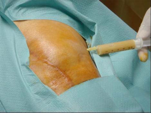 Acute Infection in Total Knee Arthroplasty: Diagnosis and Treatment
