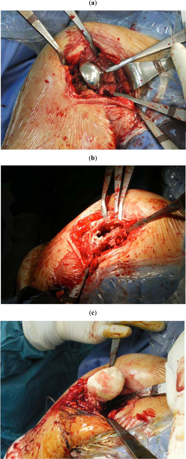 Periprosthetic Shoulder Infection Fulltext