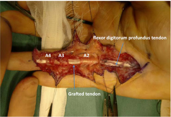 Intrasynovial Tendon Graft for Chronic Flexor Tendon Laceration of the