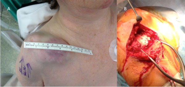 Reverse Total Shoulder Replacement with Minimal ACJ Excision