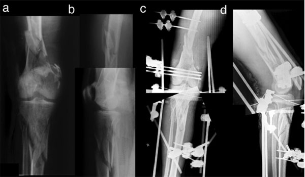 Management of the Floating Knee in Polytrauma Patients ~ Fulltext