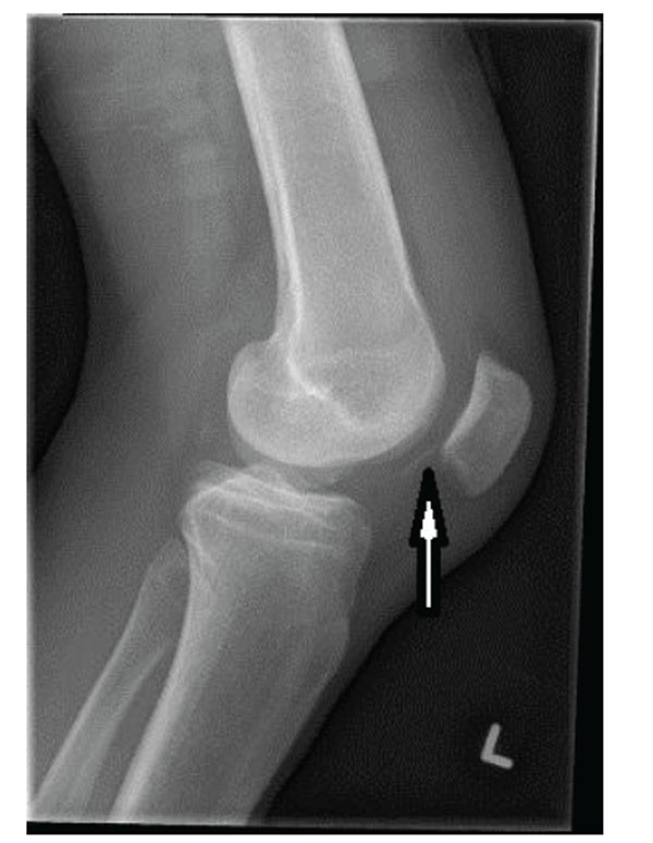 Acute Osteochondral Fractures in the Lower Extremities - Approach to