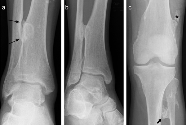 Osteochondroma-Related Pressure Erosions in Bony Rings Below the Waist