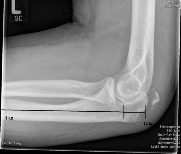 Traumatic Rupture of the Distal Triceps Tendon (A Series ...