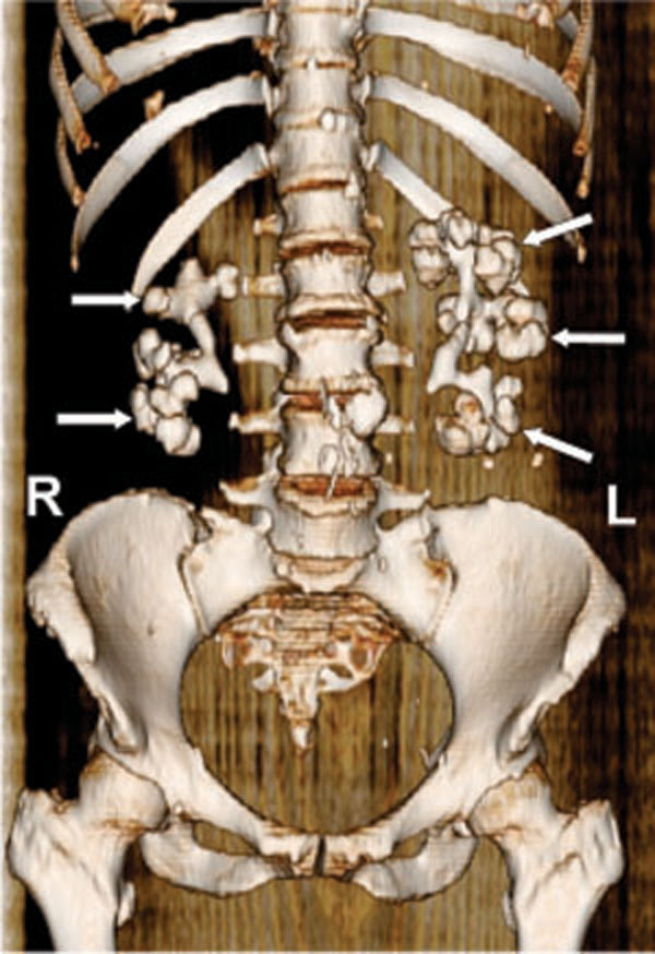 LEARNING FROM IMAGES Staghorn Calculi Fulltext