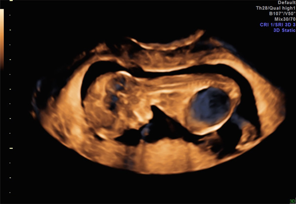 Fetal Lower Urinary Tract Obstruction An Update Fulltext