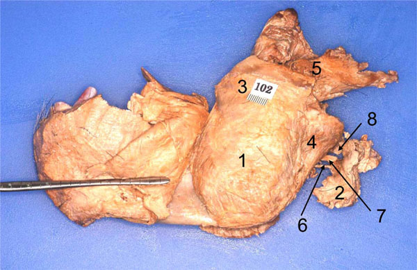 Mandibular nerve - Gross Anatomy 