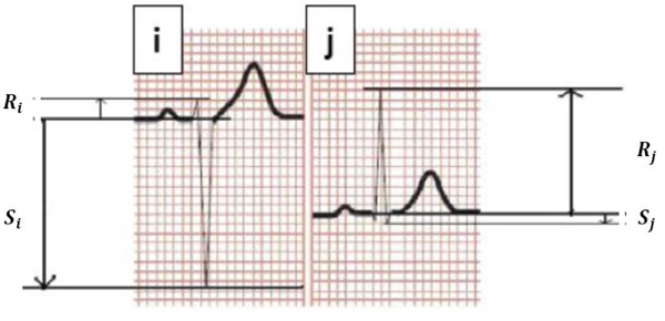 Automated Risk Identification Of Myocardial Infarction Using Relative ...