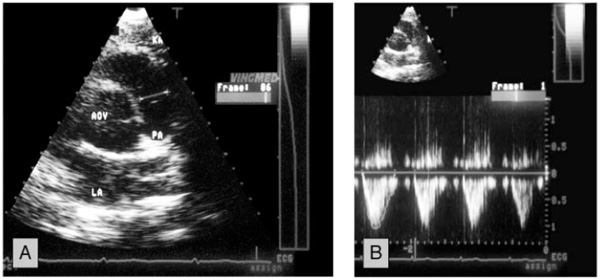 Quantitative Doppler-Echocardiographic Determination of Regurgitant ...