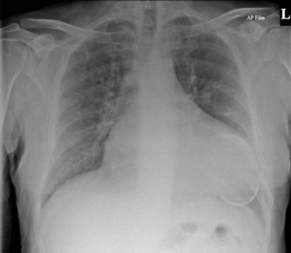 Calcified Left Ventricular Aneurysm: “An Egg in the Heart”