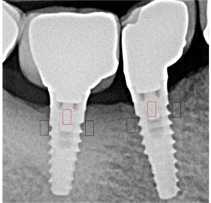 Changes of Radiographic Trabecular Bone Density and PeriImplant