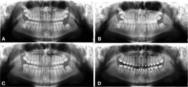 Multimodal Protocol for the Treatment of Odontogenic Keratocysts