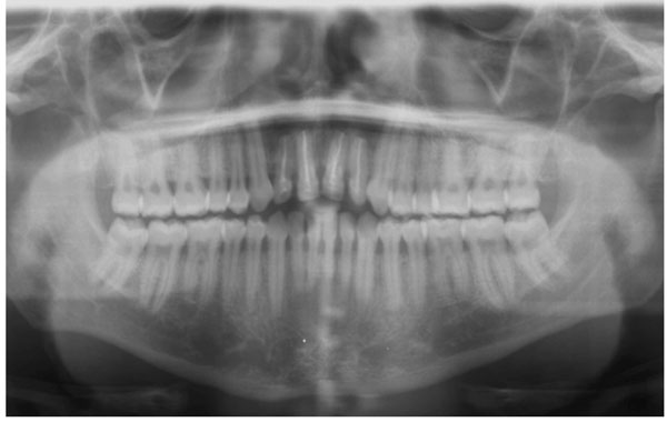 Rare Bilateral Nasopalatine Duct Cysts A Case Report Fulltext | My XXX ...