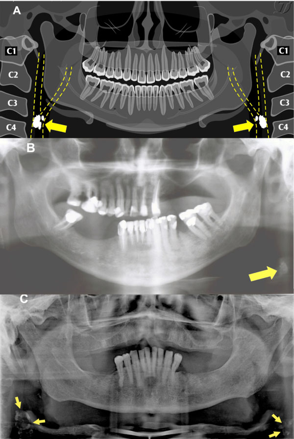 Panoramic Radiography In The Diagnosis Of Carotid Artery Atheromas And ...