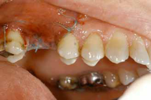 in communication oral problem Treatment Surgical In Options Oroantral Fulltext Fistula ~