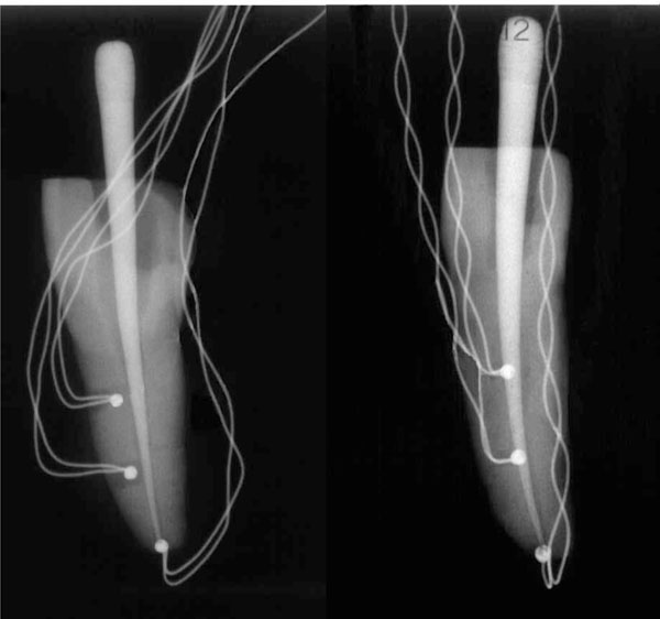 Temperature Profiles Along the Root with Guttapercha Warmed through