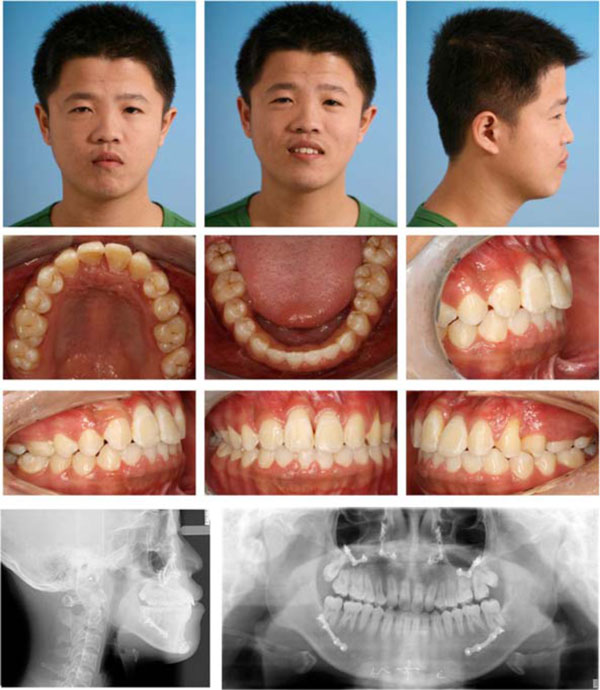 class iii malocclusion surgery