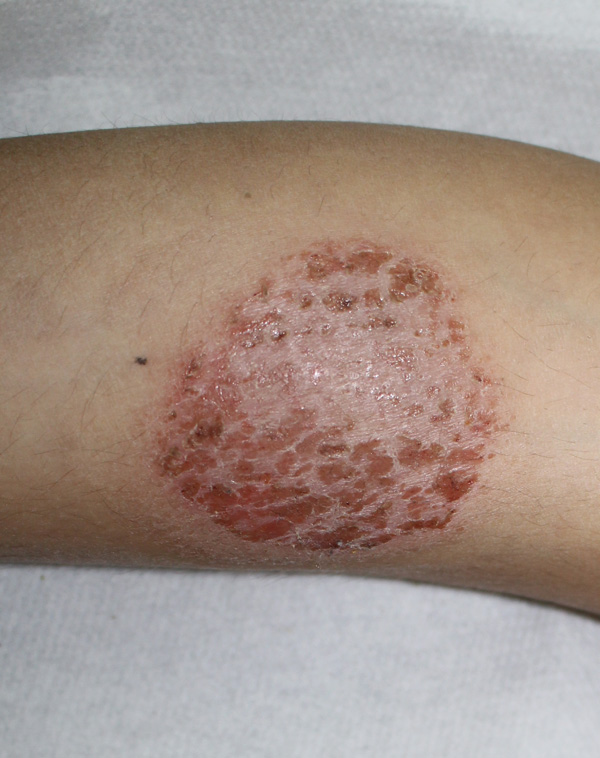 Nummular Contact Eczema Presentation Of A Pediatric Case