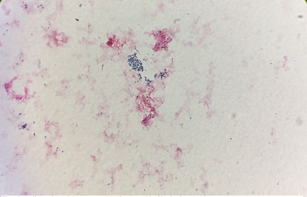 Misinterpretation of Gram Stain from the Stationary Growth Phase of
