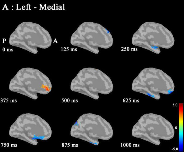 Sex Differences In Gamma Band Functional Connectivity Between The Frontal Lobe And Cortical 3869