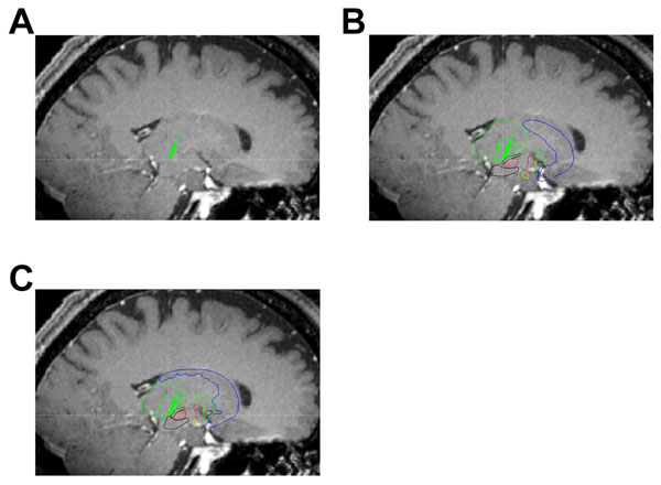 A Three-dimensional Deformable Brain Atlas for DBS Targeting. I ...