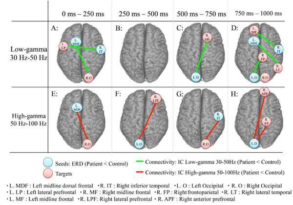 Dysfunctional Cortical Connectivity During the Auditory Oddball Task in ...