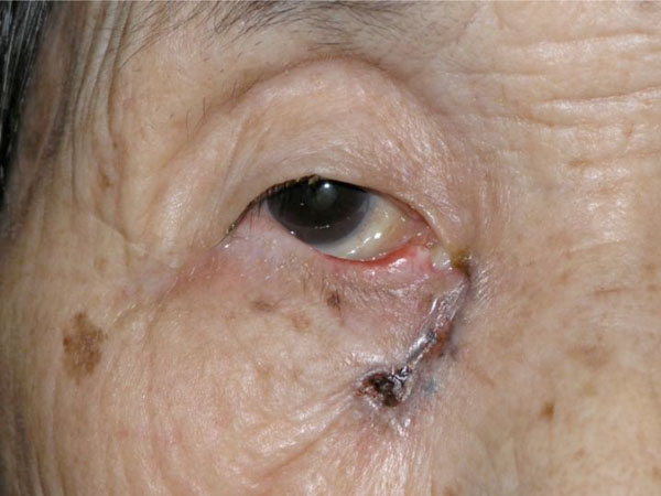Linear Basal Cell Carcinoma In An Asian Patient