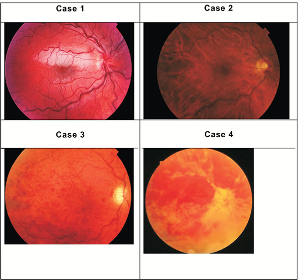 Central Retinal Vein Occlusion