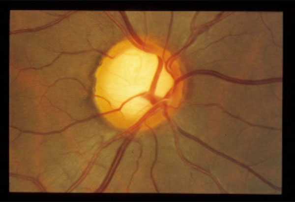 evaluating-optic-nerve-damage-pearls-and-pitfalls-fulltext