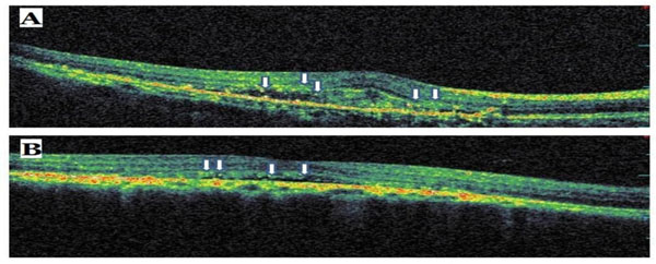 Were Located In The Outer Retinal Layers And They Created High Shadowing Effects Samples Of OCT Scan From Eyes With HRD Given Figs Were Located In The Outer Retinal Layers And They Created High Shadowing Effects Samples Of OCT Scan From Eyes With HRD Given Figs