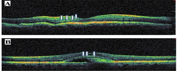 The Causes Of Hyperreflective Dots In Optical Coherence Tomography The Causes Of Hyperreflective Dots In Optical Coherence Tomography