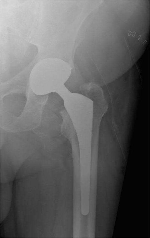 Revision of Metalonmetal Hip Arthroplasty with Well Fixed and