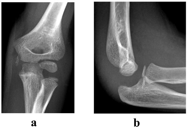 Common Paediatric Elbow Injuries
