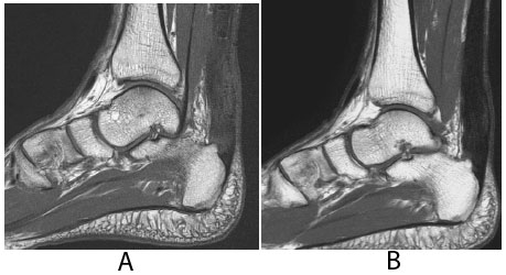 Mr Imaging Of The Achilles Tendon After Surgical Repair