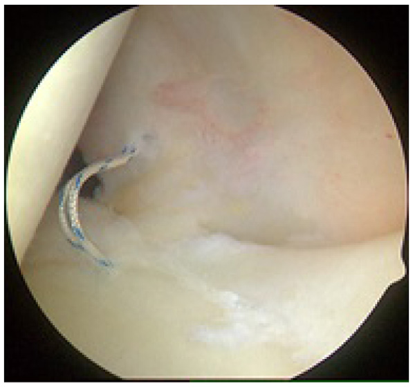 Current Concepts In The Evaluation And Management Of Type Ii Superior Labral Lesions Of The Shoulder