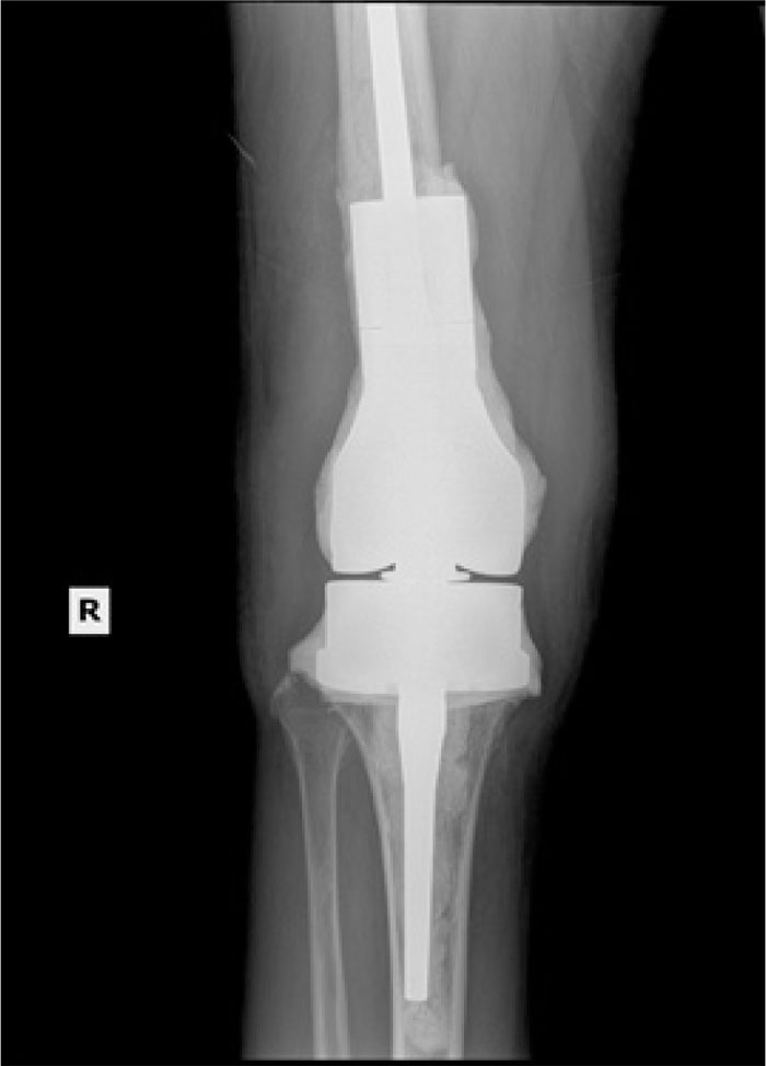Early Failures of Total Knee Patients with Nickel Allergies Secondary
