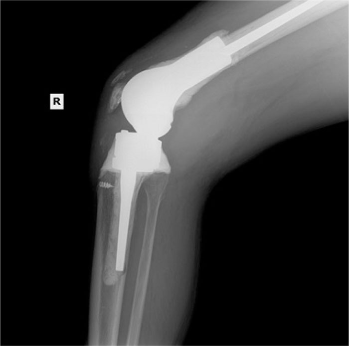 Early Failures of Total Knee Patients with Nickel Allergies Secondary