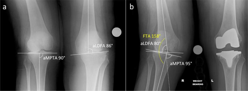 Kinematic Alignment Technique For Tka On Degenerative Knees With Severe Bone Loss A Report Of