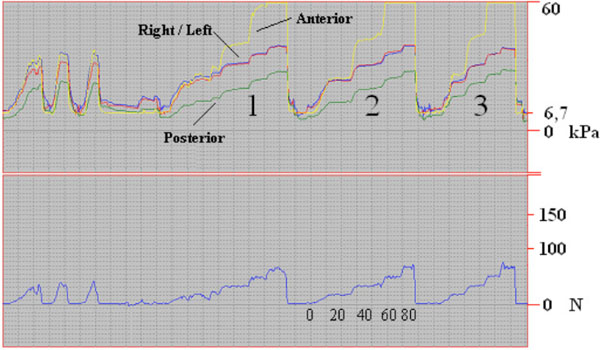 Measurements of the Exerted Pressure by Pelvic Circumferential ...