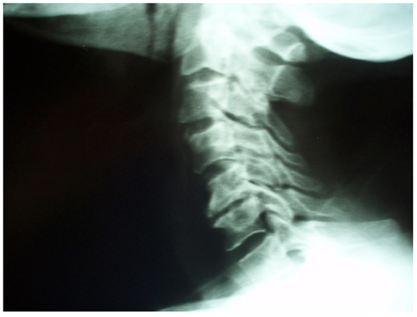 Surgical Management of Cervical Spondyloarthropathy in Hemodialysis ...