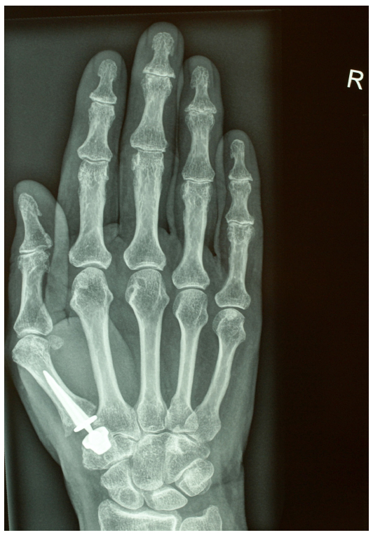 Clinical Results of 40 Consecutive Basal Thumb Prostheses and No CRPS