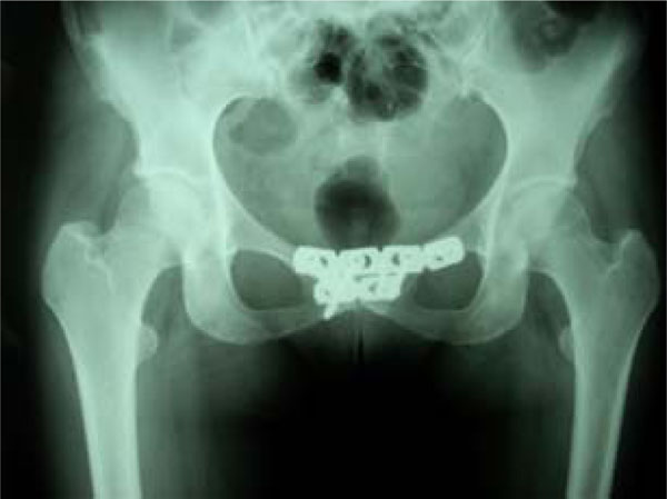 Treatment of Osteitis Pubis in Non-Athlete Female Patients ~ Fulltext